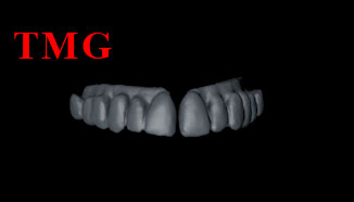 3D-Scan-LFS-TMG-Fix-Teeth-001.jpg