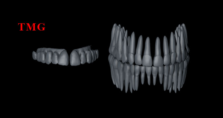 3D-Scan-LFS-TMG-Fix-Teeth-vs-Genisys-Teeth-001.jpg