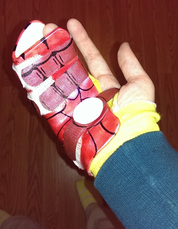 The physical therapists had a field day with this pre-surgery. My surgeon didn't recognize it but the nurses did!